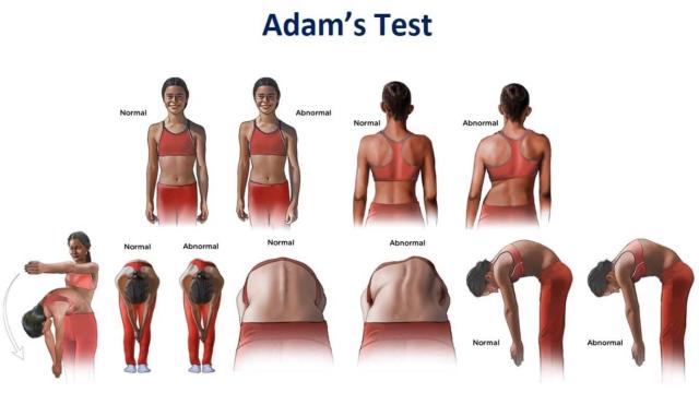 Как быстро проверить себя на искривление позвоночника: 4 простых способа
