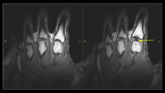 Хрустят суставы? Опасно ли это и почему не получается хрустнуть ещё раз