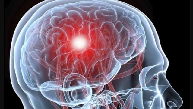 Как хруст в шее может стать причиной инсульта: реальная история