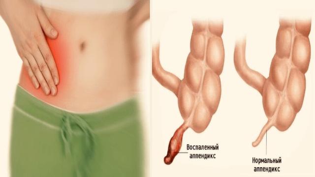Зачем нужен аппендикс и почему его зря считали бесполезным