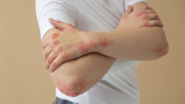 Ученые доказали связь между стрессом и появлением псориаза