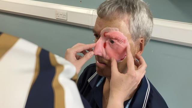 Велосипедист получил напечатанное на 3D-принтере лицо после аварии