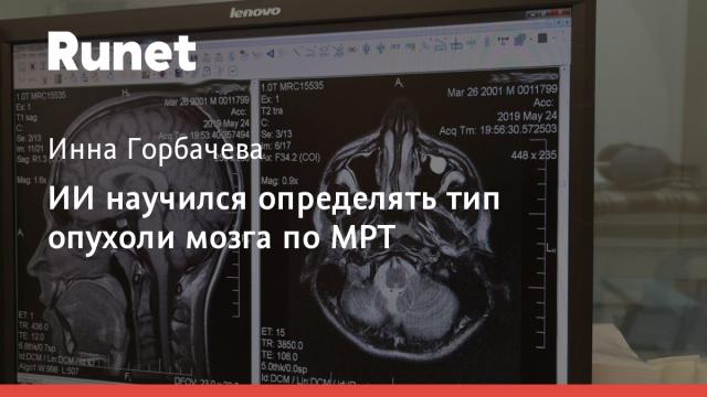 ИИ научился определять тип опухоли мозга по МРТ
