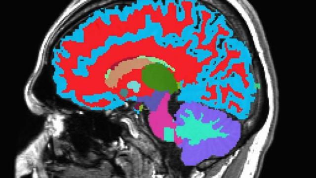Найдена причина быстрого старения мозга