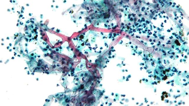 Раскрыта роль белка альбумина в борьбе с опасной инфекцией